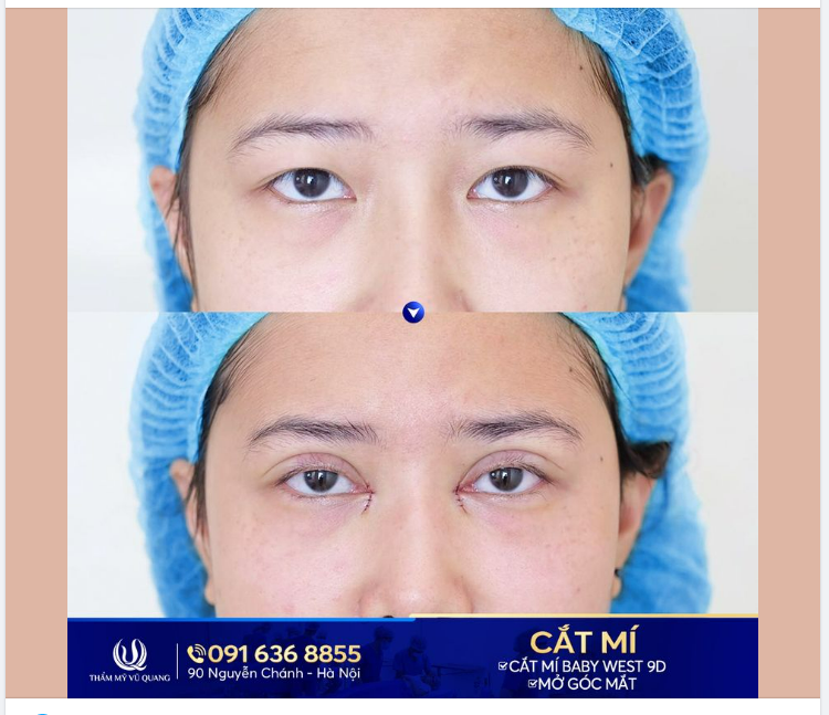 Có nên cắt mí và mở góc mắt cùng một lúc không