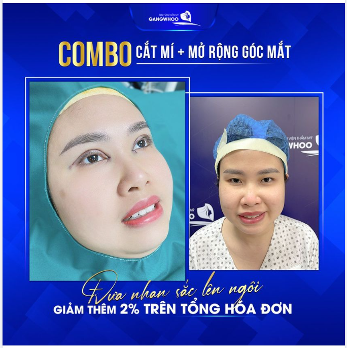 COMBO CẮT MÍ + MỞ RỘNG GÓC MẮT - ĐƯA NHAN SẮC LÊN NGÔI