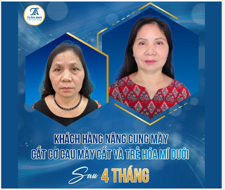 COMBO NÂNG CUNG MÀY, XÓA NHĂN CƠ CAU MÀY, CẮT TRẺ HÓA MÍ DƯỚI - NÍU KÉO TUỔI XUÂN CHO ĐÔI MẮT TRẺ TRUNG