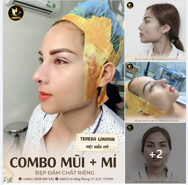 COMBO NÂNG MŨI + CẮT MÍ  ĐẸP ĐẬM CHẤT RIÊNG