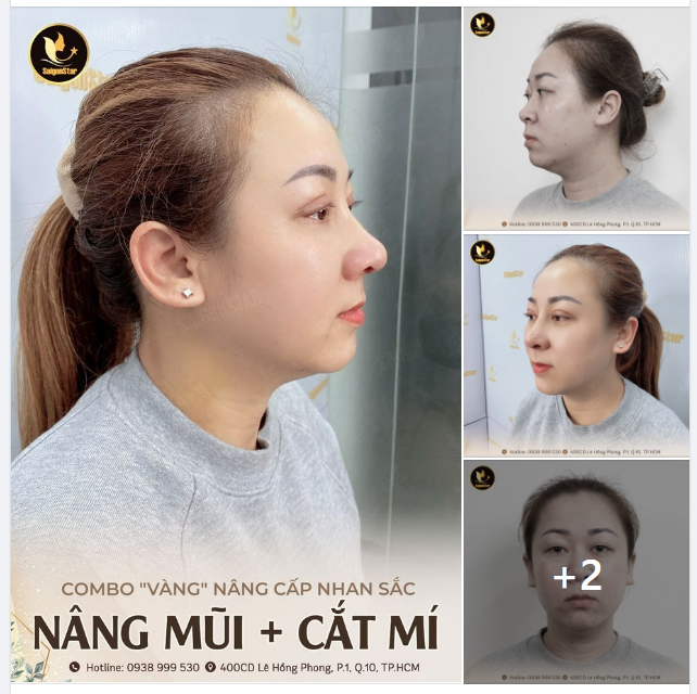 COMBO VÀNG NÂNG CẤP NHAN SẮC NÂNG MŨI + CẮT MÍ