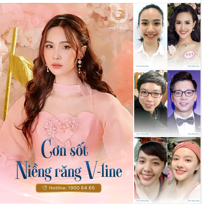 CƠN SỐT NIỀNG RĂNG V-LINE