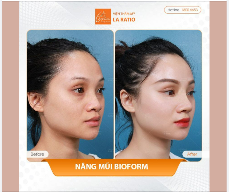 CÔNG NGHỆ NÂNG MŨI BIOFORM
