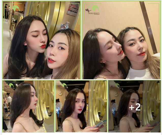 Cùng nhau tìm đến Thế Giới Đẹp để tân trang nhan sắc bằng giải pháp Nâng mũi cấu trúc sụn tự thân kết hợp Surgiform, cả 2 quý Cô vô cùng ưng ý về kết quả