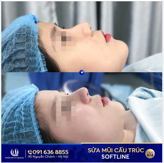 Cùng xem sự khác biệt của bạn Quỳnh Trang khi Sửa mũi cấu trúc Softline qua hình ảnh dưới đây !