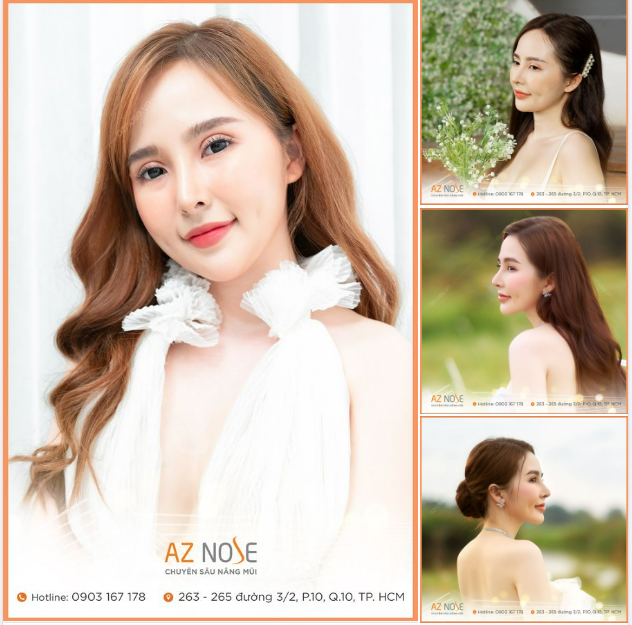 Cuộc sống viên mãn hơn cả mong đợi sau 3 năm nâng mũi