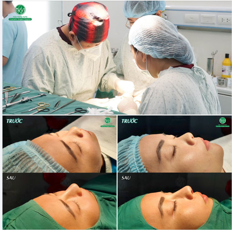 CUỐI NGÀY VỚI KẾT QUẢ MỘT CA NÂNG MŨI