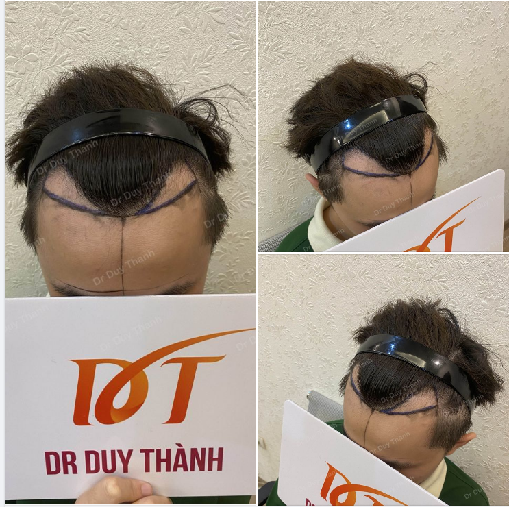 CUỐI TUẦN CẤY 900 NANG CHO BOY NGHỆ AN