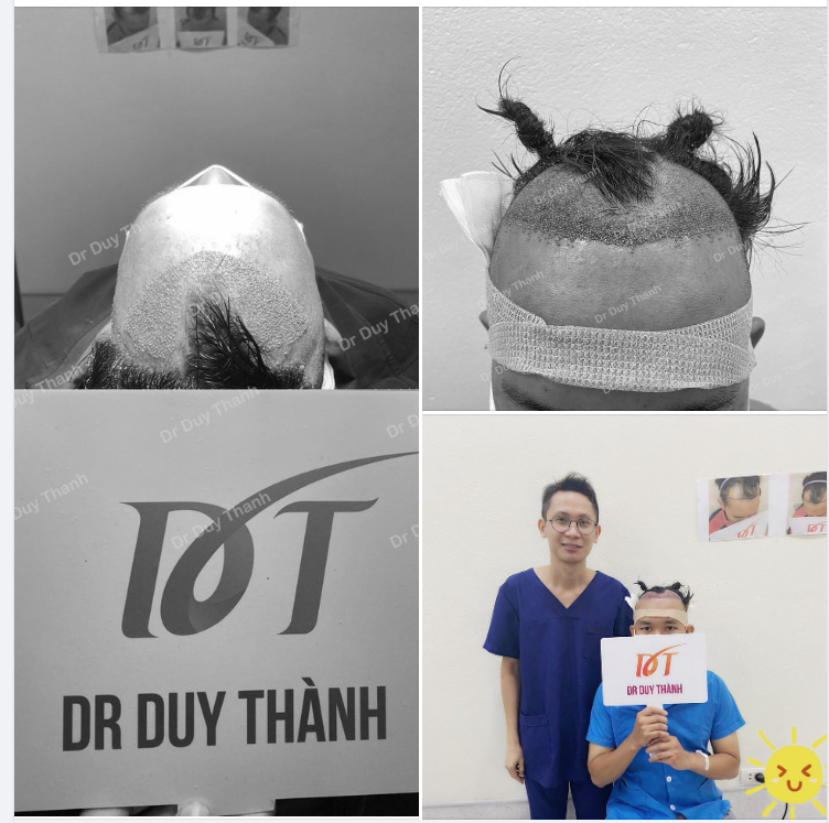 ĐÃ CẤY XONG 1600 NANG TÓC KHẮC PHỤC HÓI CHỮ M