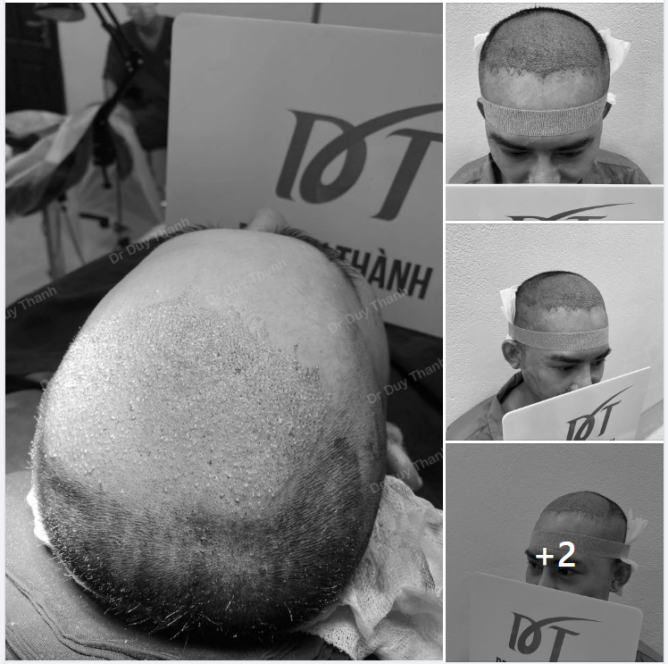 ĐÃ CẤY XONG 2000 NANG TÓC CHO BOY NHA TRANG (PHIÊN 1)