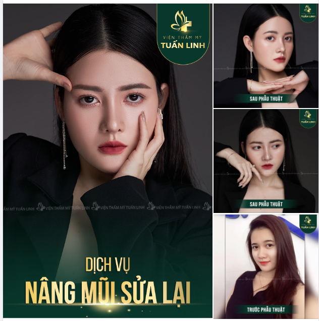 Đã từng buồn phiền vì chiếc mũi đã nâng nhưng không ưng ý của mình, cô nàng Y.N đã quyết tâm nâng lại chiếc mũi của mình theo đúng mong muốn.