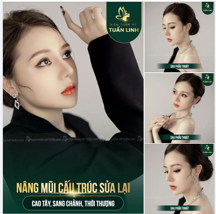 ĐÃ TỪNG SỬA MŨI NHƯNG KHÔNG ƯNG Ý - VẪN QUYẾT ĐỊNH TRAO TRỌN NIỀM TIN NƠI TUẤN LINH!!!