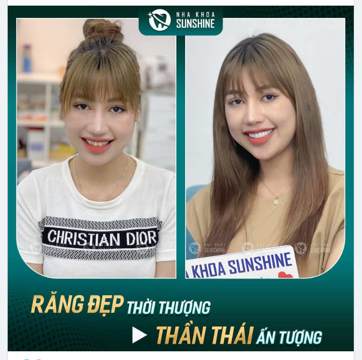 Đã xinh nay lại càng xinh hơn ​​​​​​​-  Nhờ 18 răng sứ Lava Plus