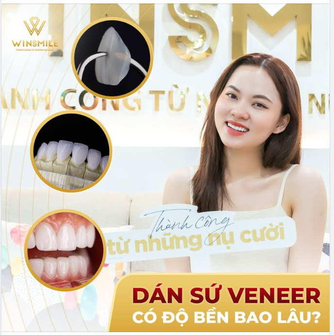 DÁN SỨ VENEER CÓ ĐỘ BỀN BAO LÂU?