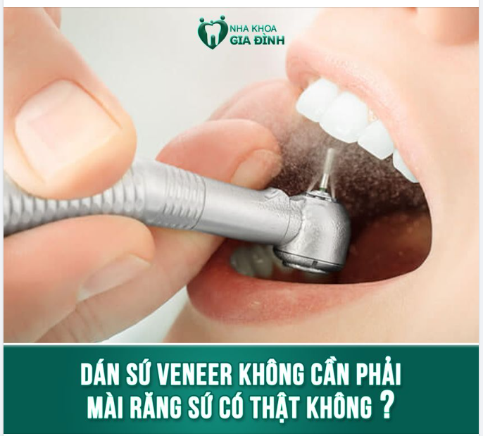 DÁN SỨ VENEER CÓ NHẤT THIẾT PHẢI MÀI RĂNG?