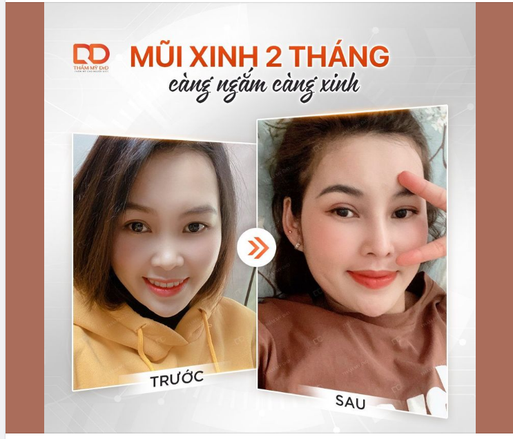 DÁNG MŨI 2 THÁNG - CÀNG NGẮM CÀNG XINH
