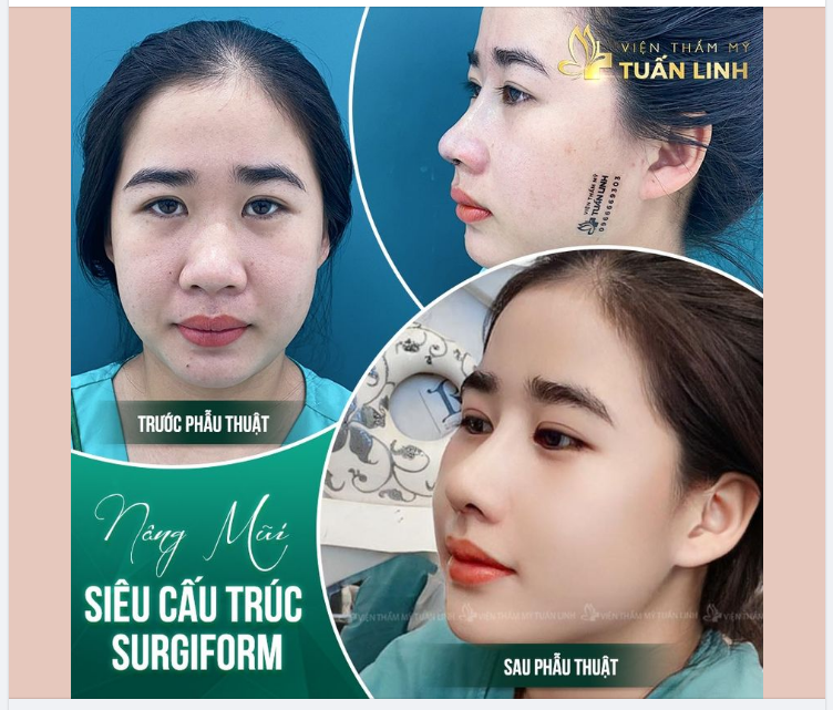 DÁNG MŨI ANGEL LINE TỰ NHIÊN VỚI ĐẦU MŨI BAY THANH TÚ