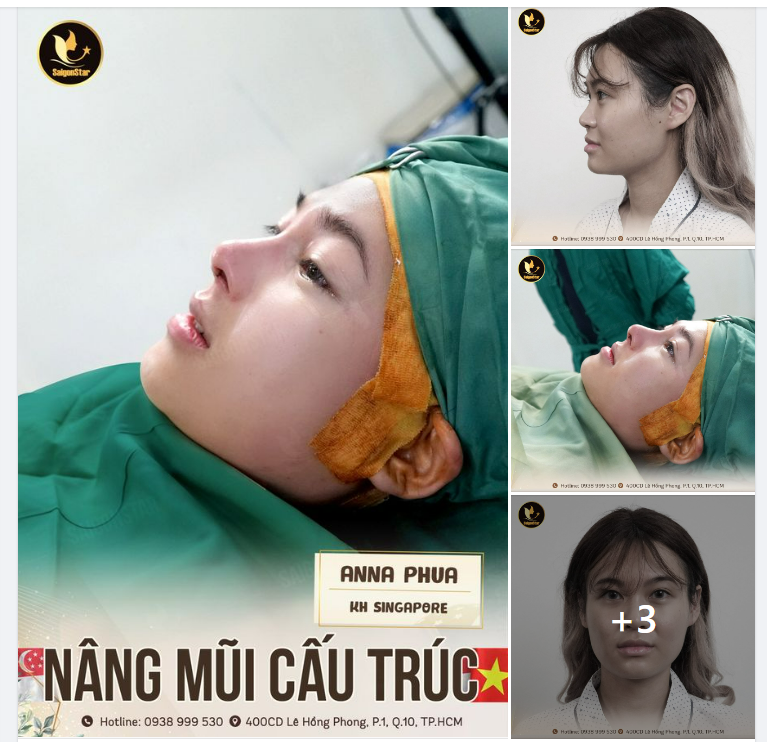 DÁNG MŨI ĐẸP HOÀN HẢO CHO BẠN KHÁCH NGƯỜI SINGAPORE