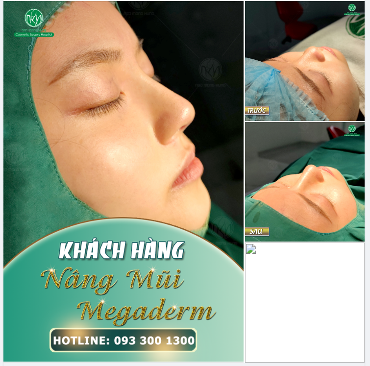 DÁNG MŨI ĐƯỢC THIẾT KẾ RIÊNG CHO KHÁCH HÀNG