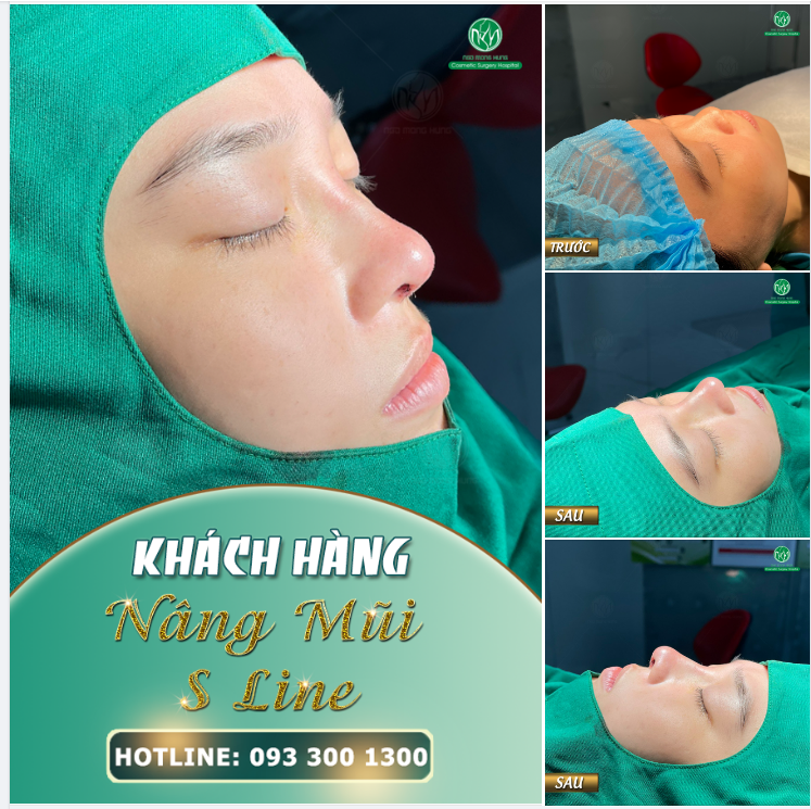 DÁNG MŨI S LINE VỪA ĐẸP VỪA TỰ NHIÊN
