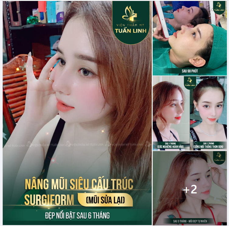 DÁNG MŨI SIÊU CẤU TRÚC SURGIFORM SAU 6 THÁNG