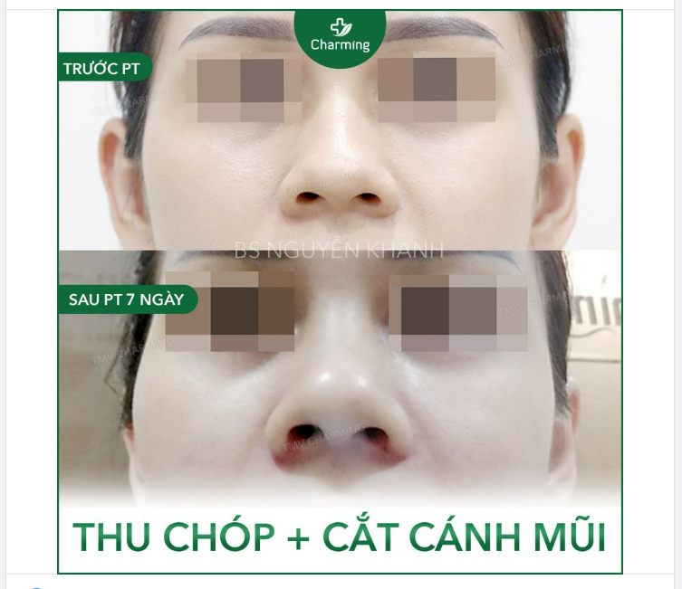 Dành cho những bạn chưa biết khi nào chúng ta cần thu chóp mũi và cắt cánh thì bạn hãy nhìn hình bên dưới và so sánh chiếc mũi này nhé.