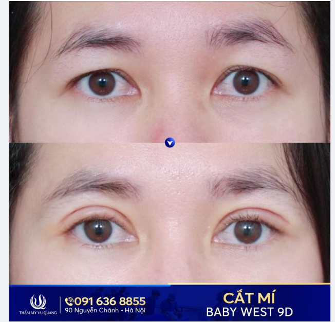 Đây là lý do bạn K.H đến với Thẩm mỹ Vũ Quang để Cắt mí Baby West 9D.
