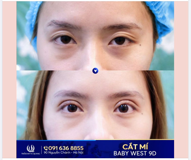 Để mắt đa mí, u buồn trở thành quá khứ