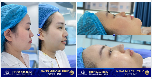 Đến Thẩm mỹ Vũ Quang - Xóa bỏ mũi gồ, mũi thô to.