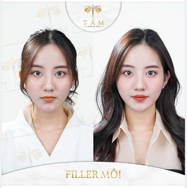 Đến với Tấm để sở hữu đôi môi sexy, quyến rũ theo ý muốn của nàng với công nghệ tạo hình môi đỉnh cao