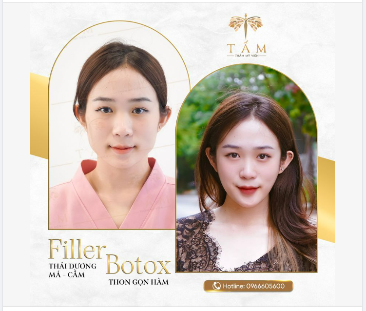 ĐẸP CHUẨN HOT GIRL CÙNG FILLER - BOTOX