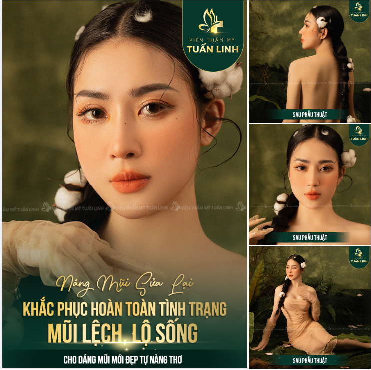 ĐẸP TỰA NÀNG THƠ SAU NÂNG MŨI SỬA LẠI TẠI TUẤN LINH.