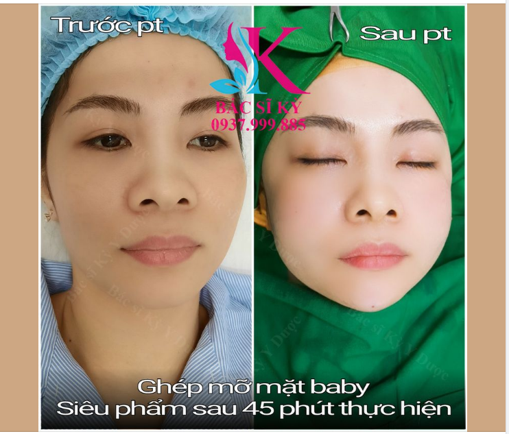 Dịch vụ ghép mỡ mặt baby tại Bs Kỳ Y Dược