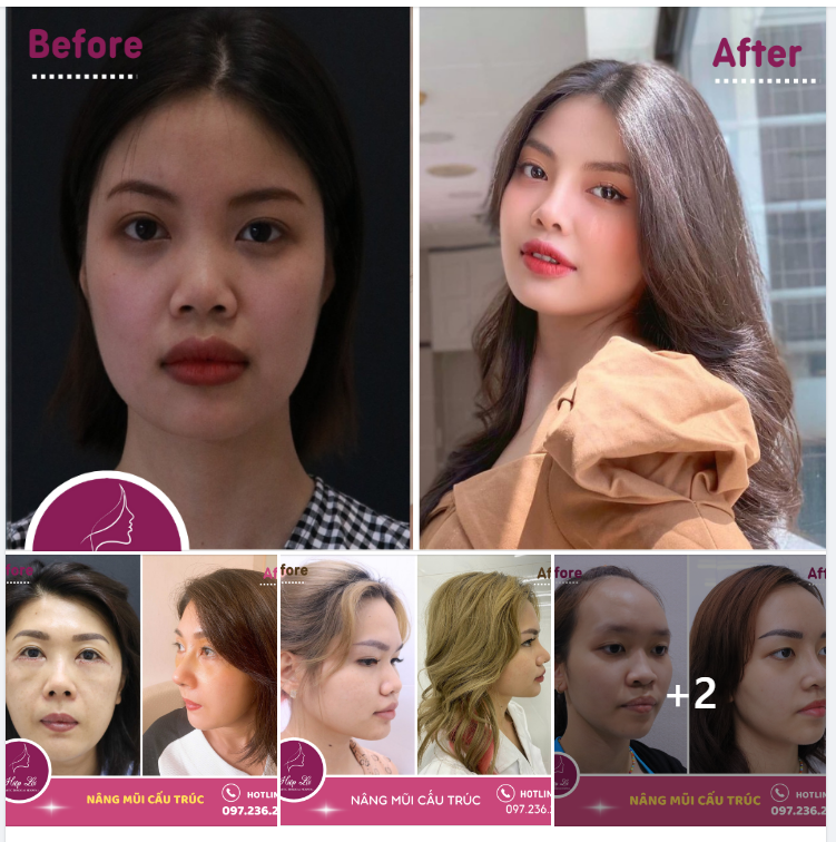 Điểm danh các Form mũi Hot Trend được ưa chuộng nhất Hiệp Lợi hiện nay