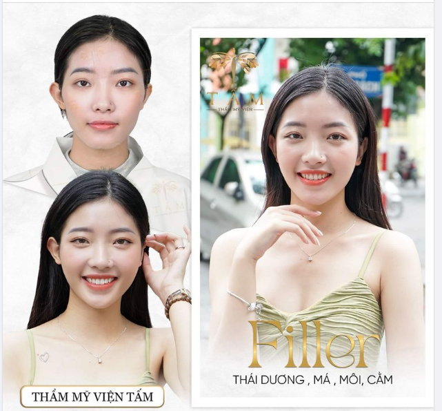 DIỆN MẠO XINH ĐẸP HƠN CÙNG FILLER - THÁI DƯƠNG - MÁ - MÔI - CẰM