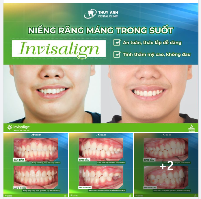 ĐIỀU TRỊ CUNG HÀM HẸP, RĂNG KHẤP KHỂNH HIỆU QUẢ VỚI INVISALIGN