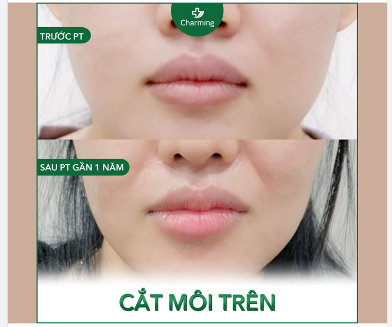 Đỉnh môi có rõ nét mà khoảng cách giữa hai đỉnh môi và khoé môi không hài hoà thì cũng là một đôi môi cần cải thiện.