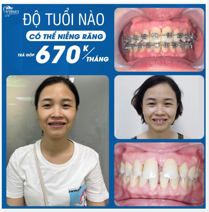 ĐỘ TUỔI NÀO CÓ THỂ NIỀNG RĂNG?