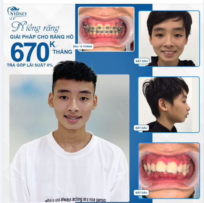 ĐỐI TƯỢNG NÀO NÊN NIỀNG RĂNG MẮC CÀI KIM LOẠI