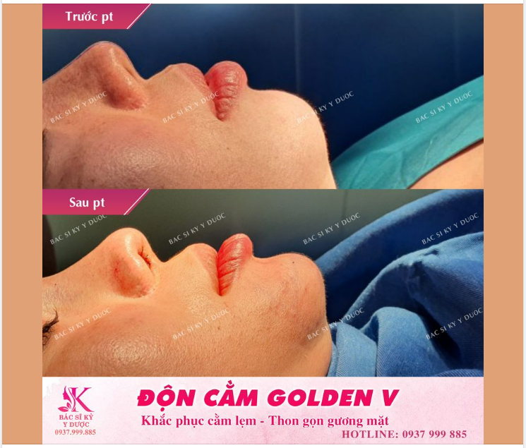 Độn cằm Golden - V là phẫu thuật thẩm mỹ khắc phục tình trạng cằm ngắn, cằm lẹm, đem lại dáng cằm thon gọn cân bằng.