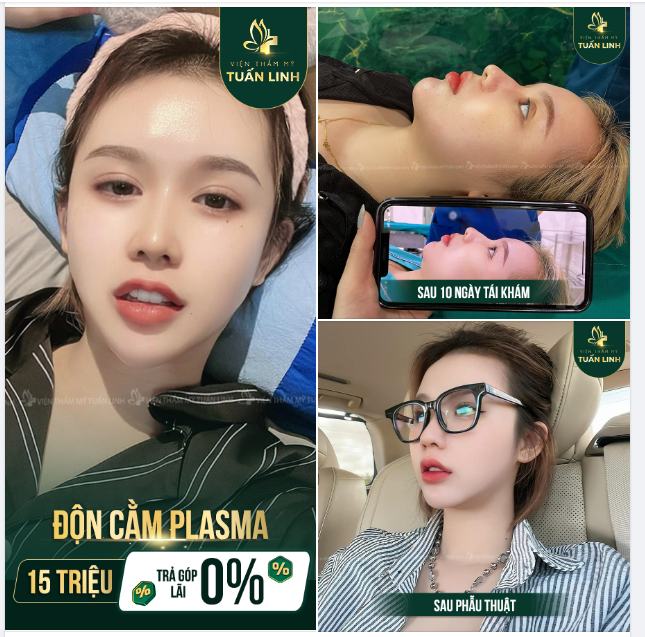ĐỘN CẰM PLASMA - CHUẨN VLINE - ĐẸP TỰ NHIÊN