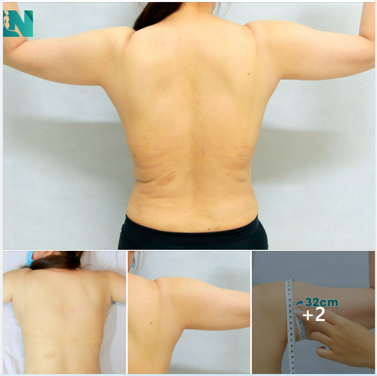 ĐỢT 2 HÚT MỠ TẠO DÁNG THẨM MỸ, CẤY MỠ TẠO DÁNG V.3 CÂN CHỈNH DÁNG VÓC CHO CHỊ KH ĐẾN TỪ LONG AN, ĐÃ HÚT MỠ BỤNG TẠI BỆNH VIỆN 1 NĂM TRƯỚC. TRỰC TIẾP 15H00 – 15H30 HÔM NAY