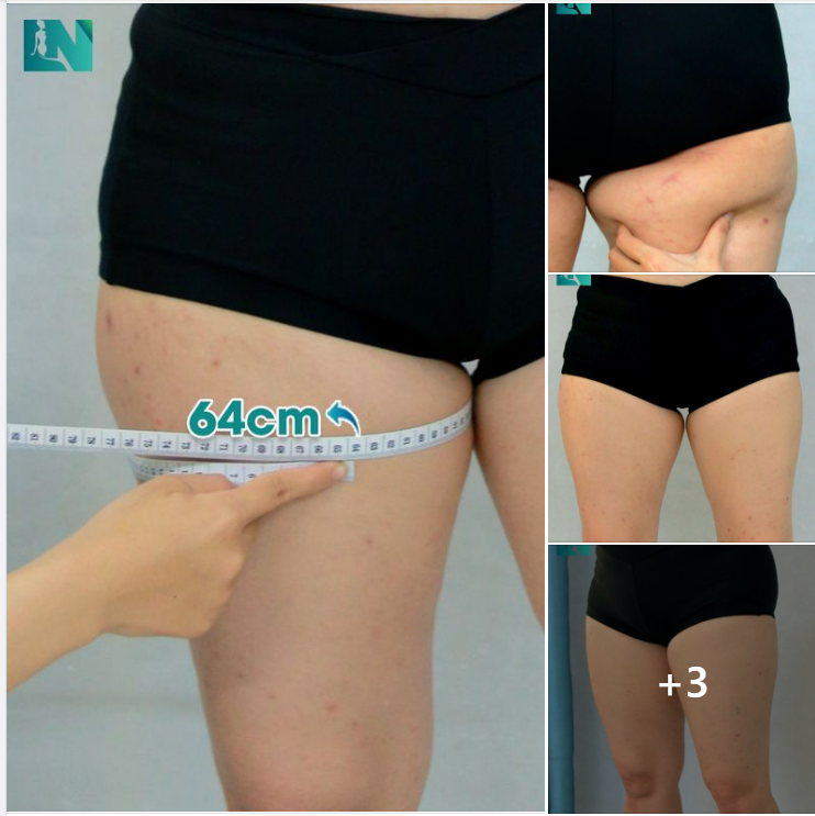 ĐỢT 3 HÚT MỠ TẠO DÁNG THẨM MỸ VÙNG ĐÙI, CẤY MỠ TẠO DÁNG VÒNG 1 CHO CHỊ KH 42 TUỔI, ĐÃ TỪNG HÚT MỠ BỤNG, TAY LƯNG NÁCH 2 NĂM TRƯỚC. TRỰC TIẾP 15H00 15H30 HÔM NAY.