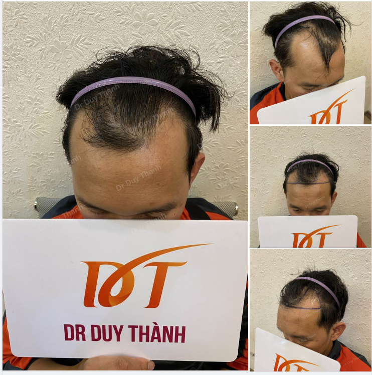 DR DUY THÀNH VÀ EKIP CHUẨN BỊ CẤY 1600 NANG TÓC TRỊ HÓI CHỮ M