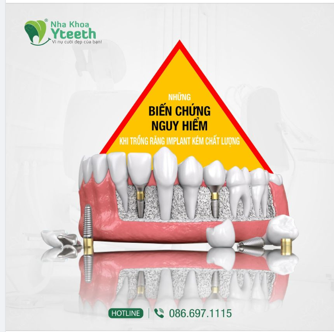 Đừng ham trồng răng Implant rẻ để rồi phải "trả giá đắt"!