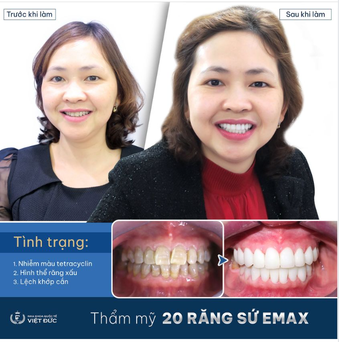 F5 HÀM RĂNG XỈN MÀU, SỞ HỮU NGAY NỤ CƯỜI THỜI THƯỢNG