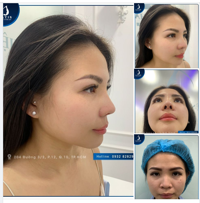 Feedback Chị khách sau 2 tuần thay đổi như thế nào sau 2 tuần làm combo tại Latin