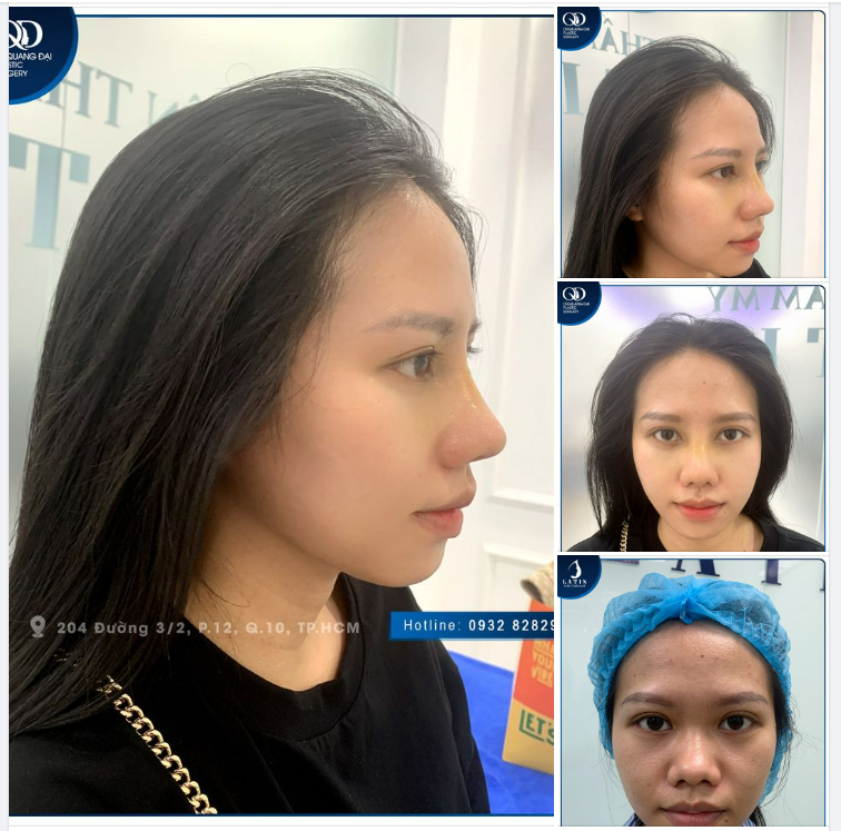 Feedback Mũi bán cấu trúc 10 ngày
