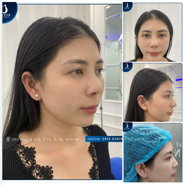 Feedback Mũi bán cấu trúc sau 2 tuần nâng mũi tại Latin