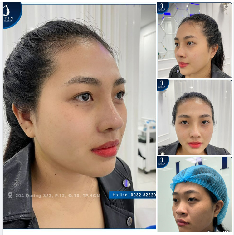 Feedback Mũi cấu trúc 10 ngày có gì hot